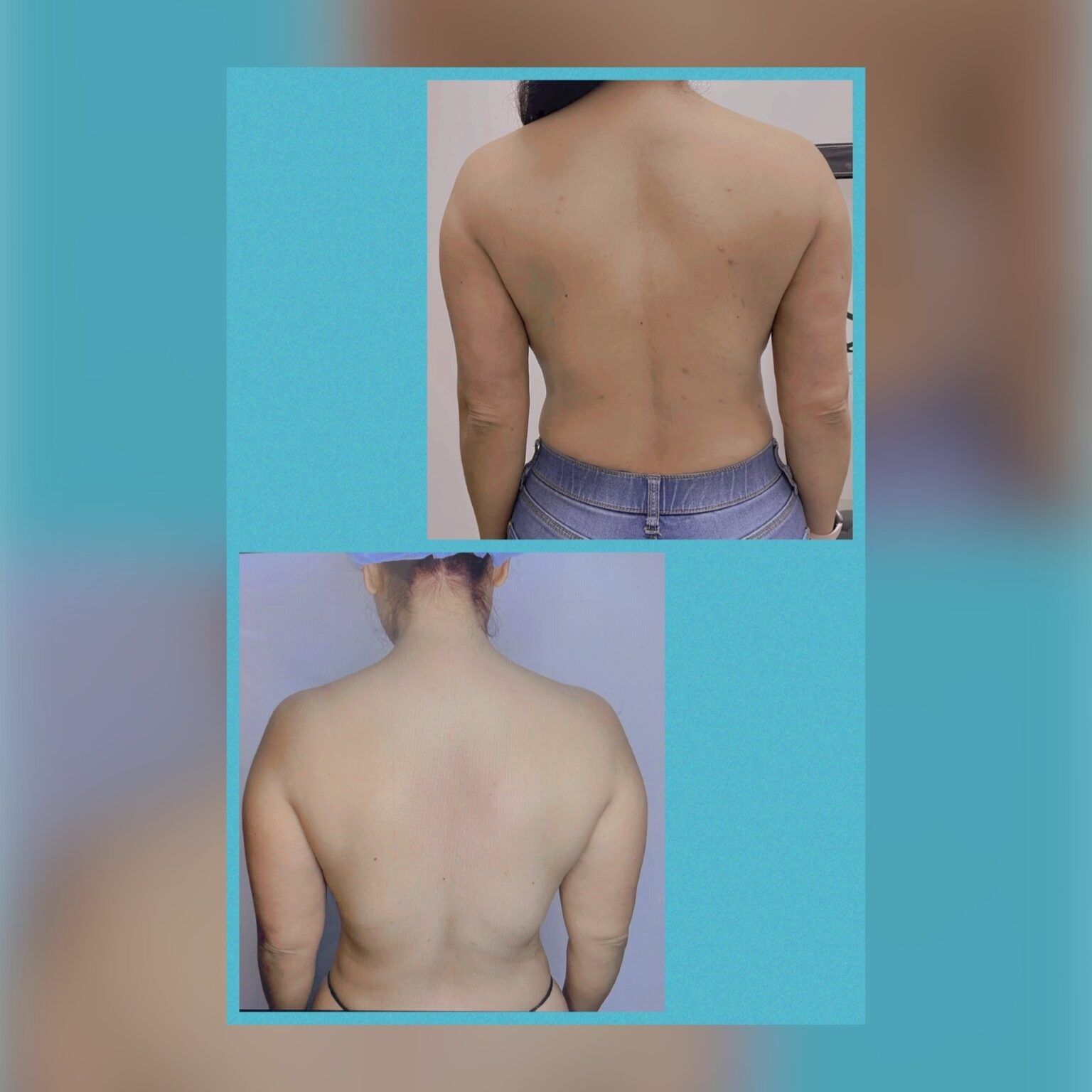 Smartlipo 8
