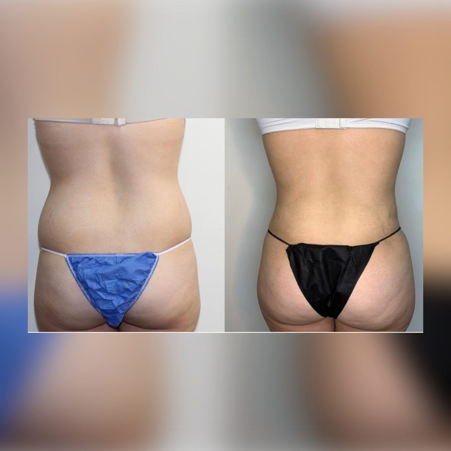 Smartlipo 9