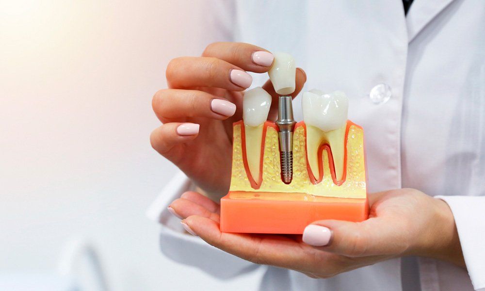 O que é implante dentário?