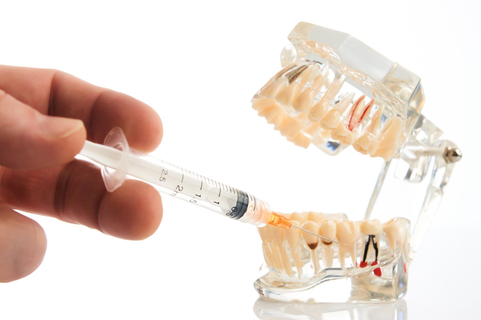 O que é implante dentário?