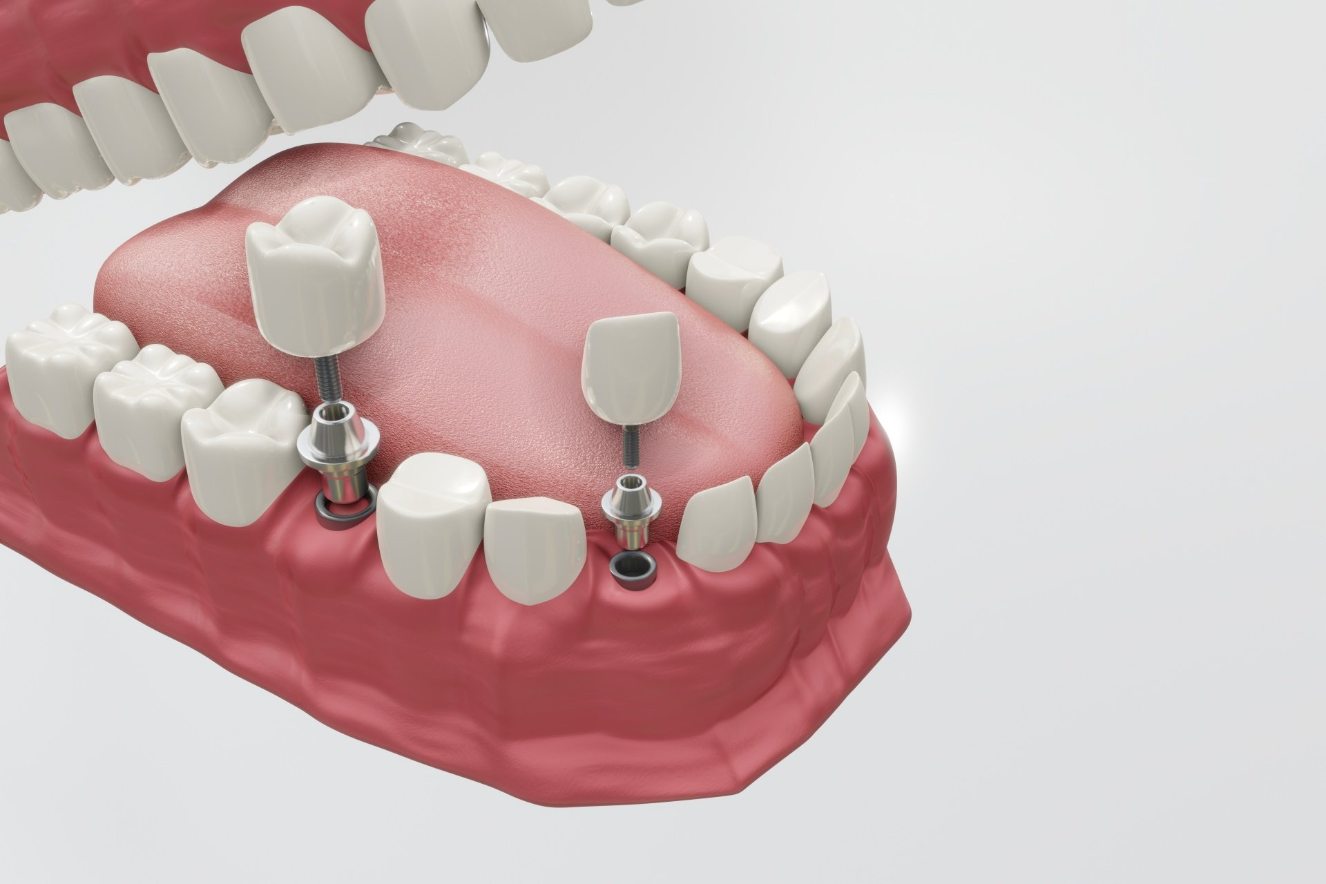Implante dentário em Belém Implante dentário em Belém