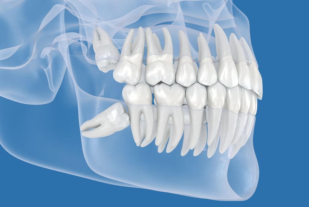 Dente do siso: por que alguns têm e outros não?