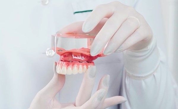 Implante dentário dói? Saiba tudo sobre o procedimento