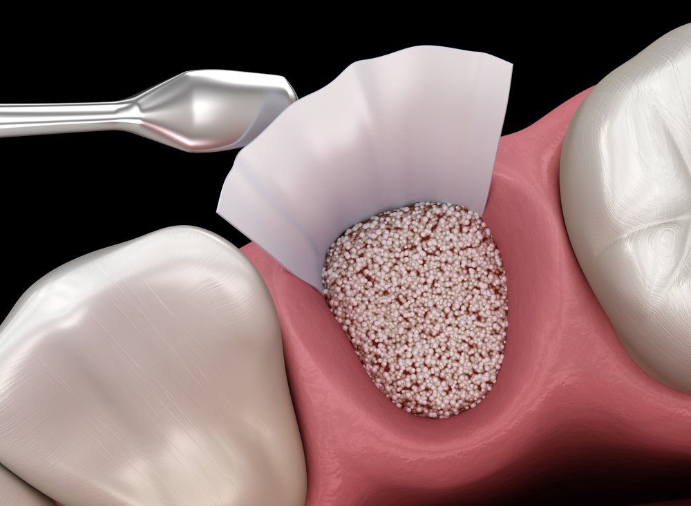 O que é implante dentário? O que é implante dentário?
