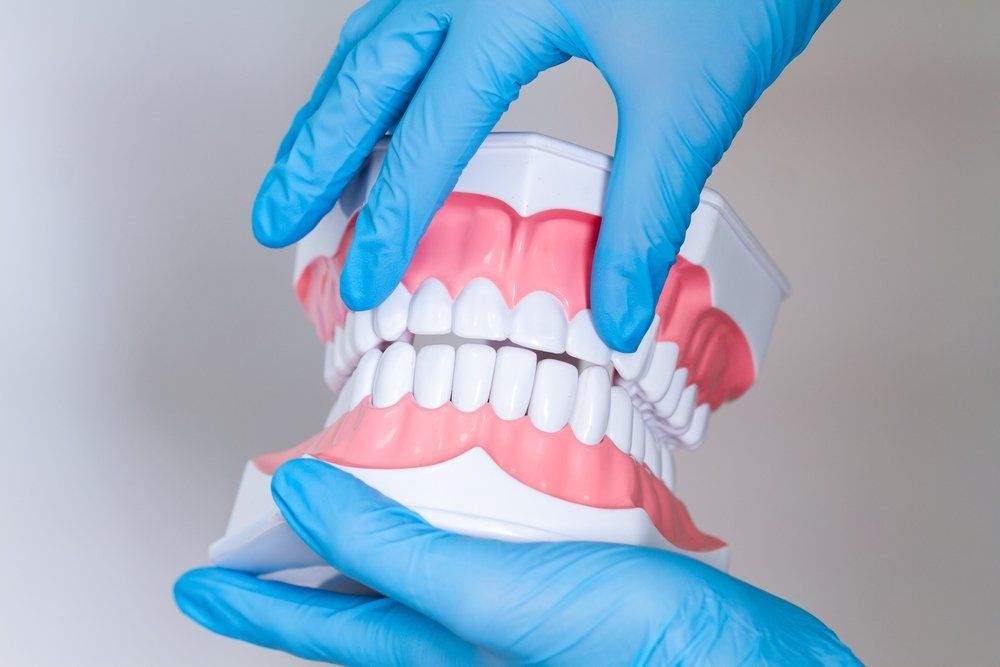 O que é implante dentário? O que é implante dentário?