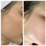 Side-by-side photos of a person's face. The left shows uneven skin tone. The right shows smoother, even skin tone.
