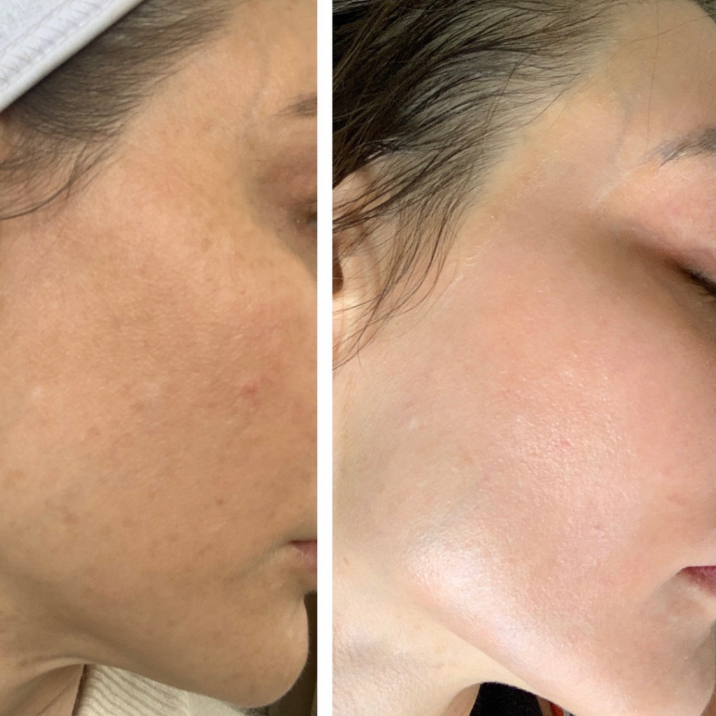 Two side-by-side photos of a person's face. Left side: skin with dark spots. Right side: smoother skin 
