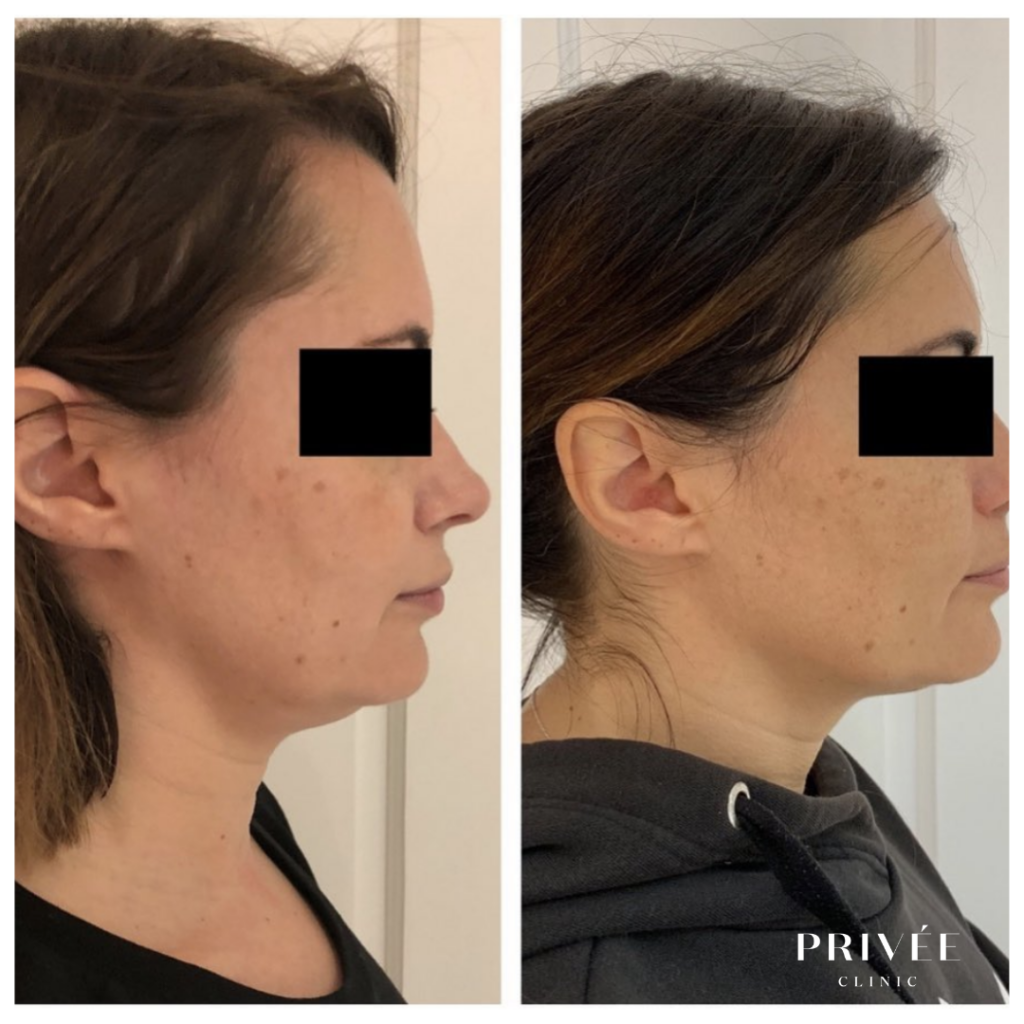 Side-by-side profile views of a person’s face and neck before and after a cosmetic procedure.