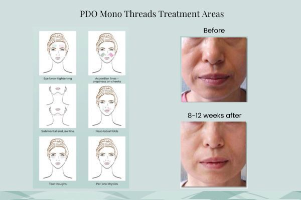 Diagram of treatment areas for PDO mono threads, plus before/after photo of face, showing wrinkles reduced.