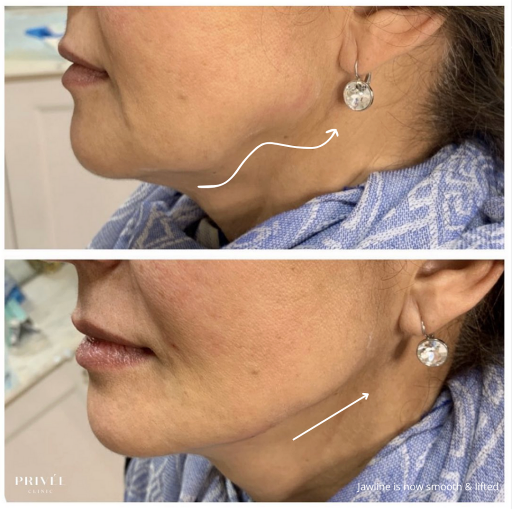 Two side-profile views of a person's face and neck, before and after a treatment, showing a smoother jawline.
