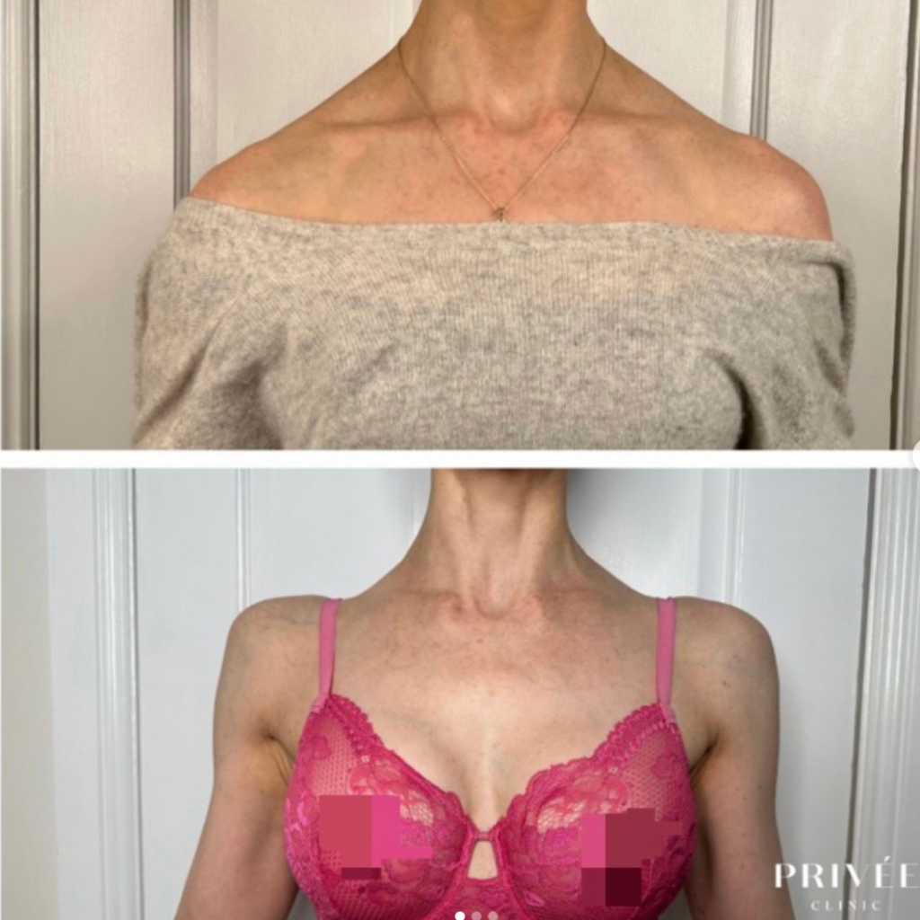 Two photos of a person's upper body; the top with a sweater and the bottom with a pink bra.