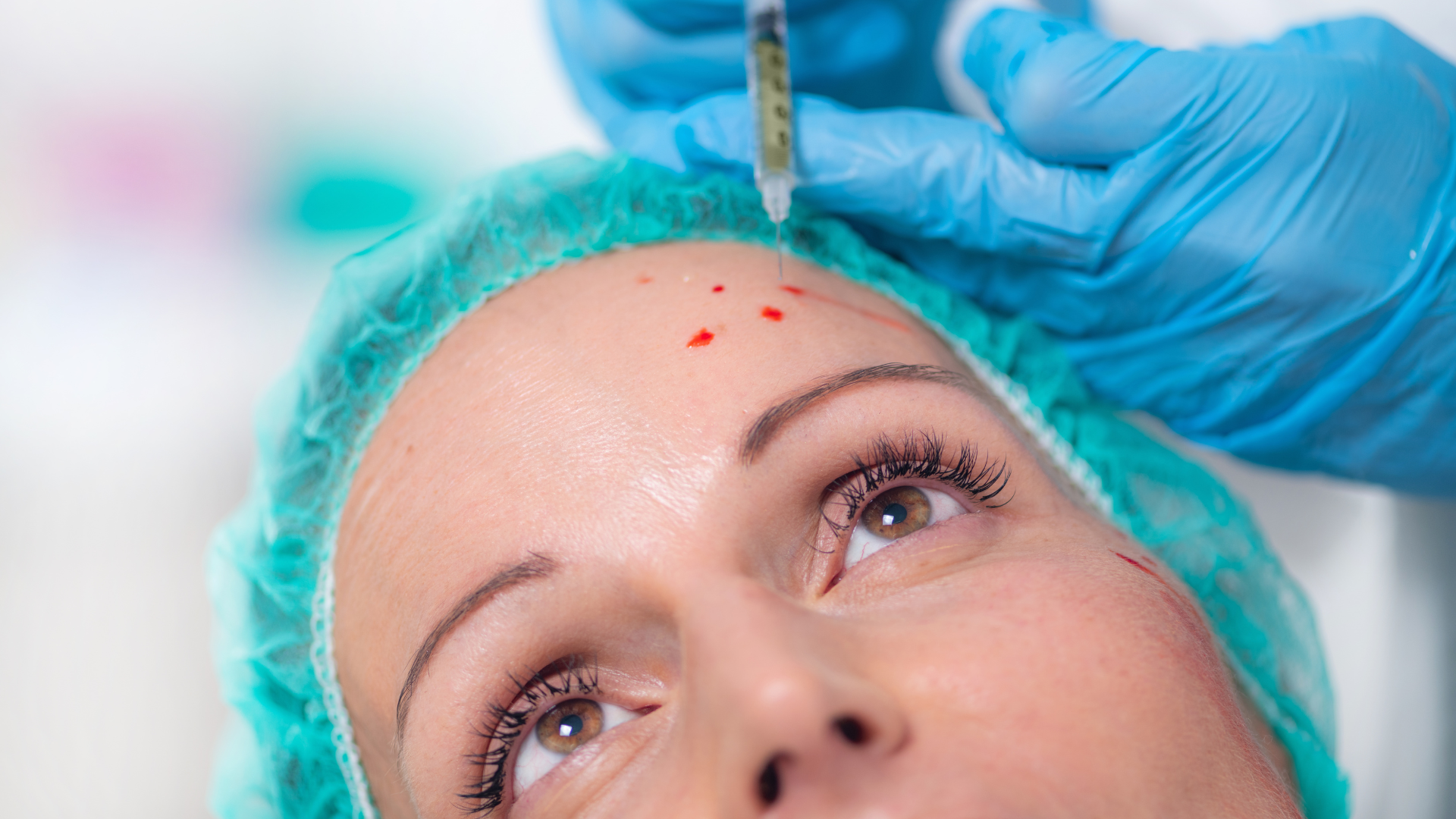 Cosmetic injection being administered to a woman’s forehead with a gloved hand