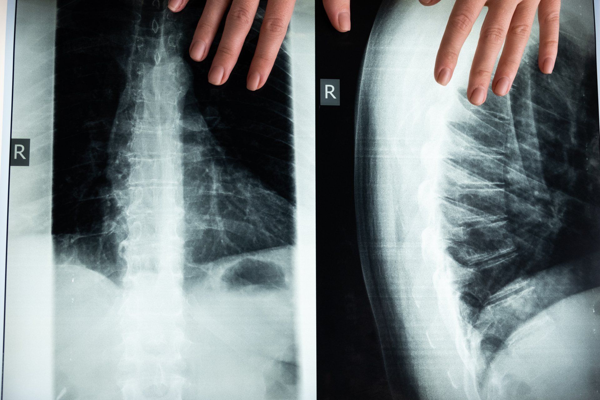 A person holding an x-ray photo