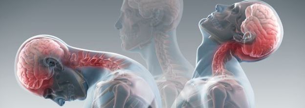 X-Ray perspective image of whiplash