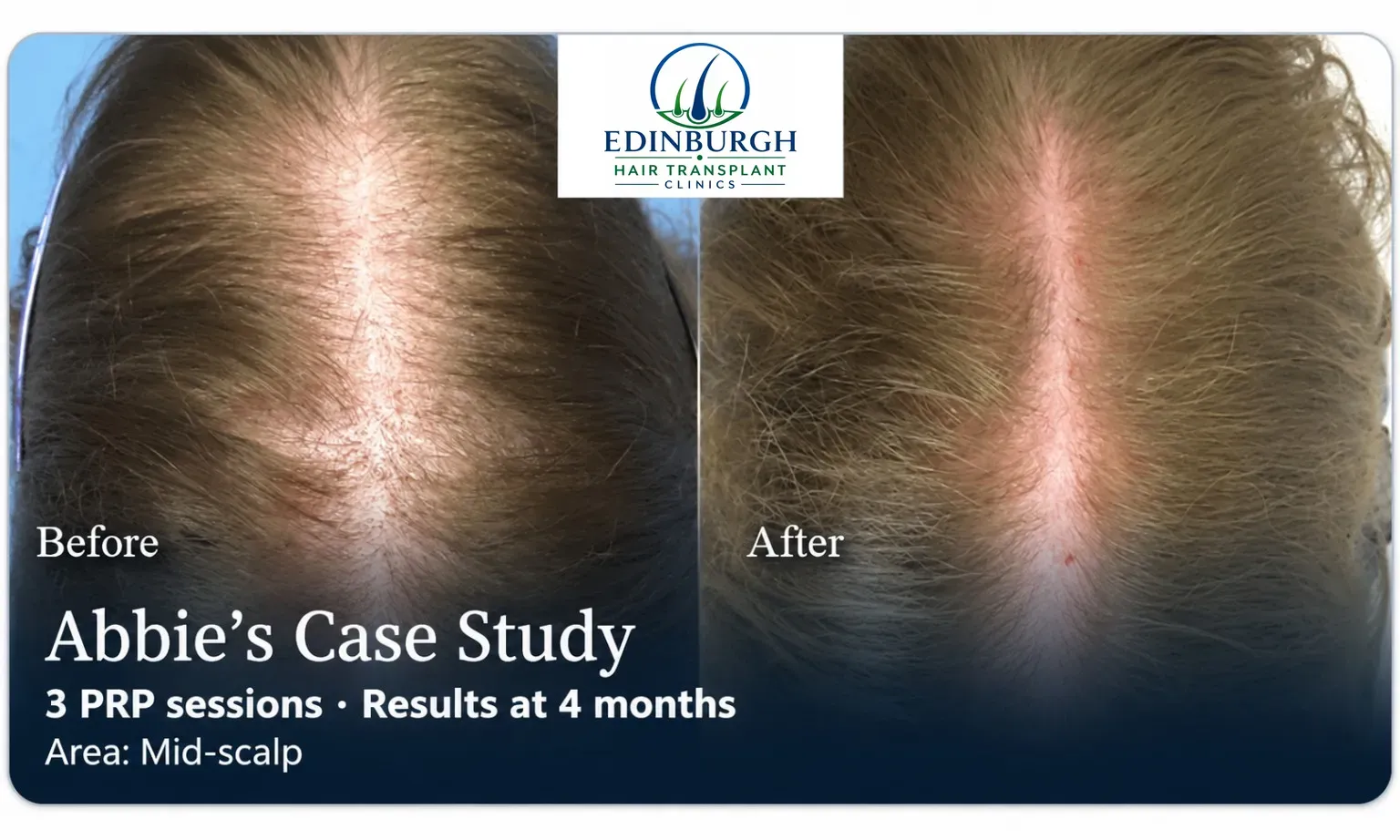 Abbie: PRP, Mid-scalp, 3 prp sessions, results at 4 months