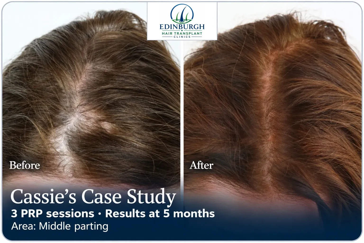 Cassie: PRP, Middle parting, 3 prp sessions, results at 5 months