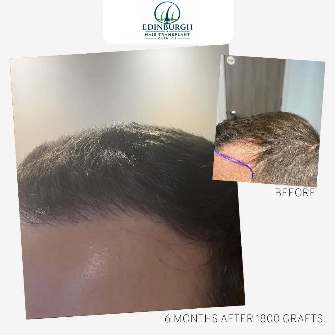 Eddie hair transplant before and after comparison