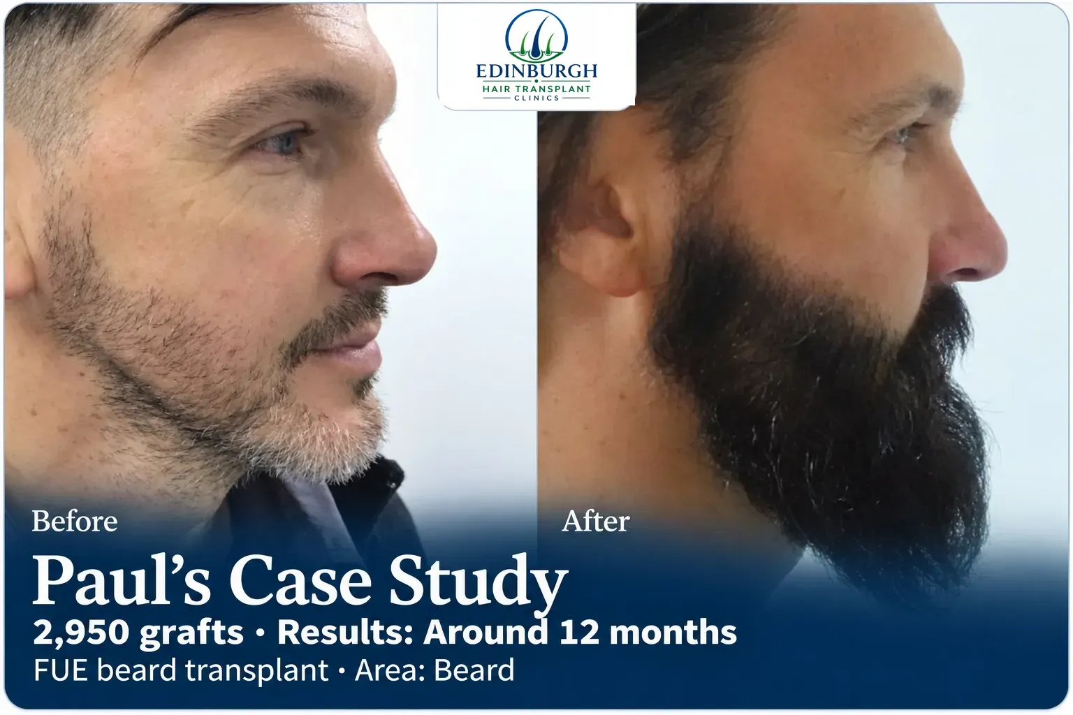 Paul: FUE beard transplant, Beard, 2,950 grafts, results at 12 months