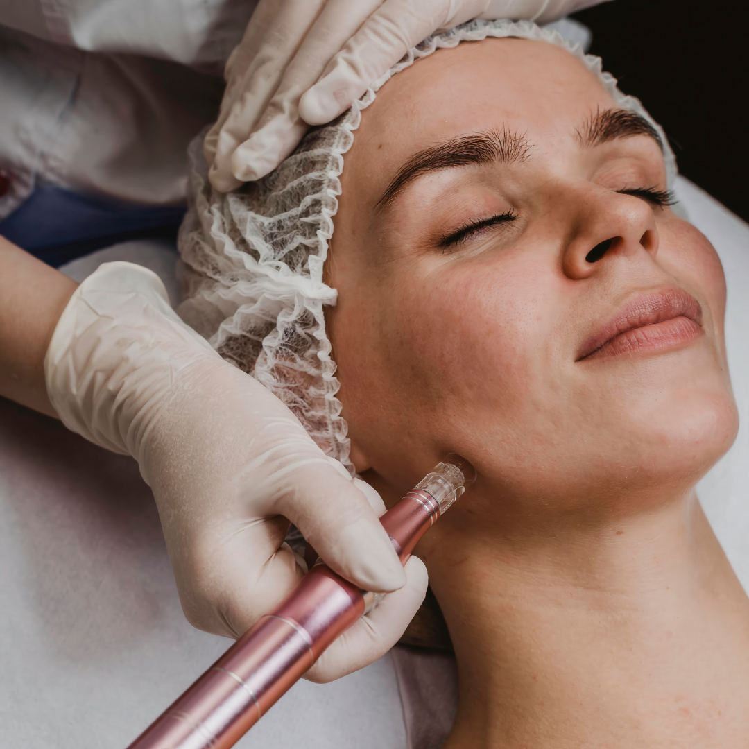 A person receiving a microneedling treatment on their cheek with a handheld device in a clinical setting.