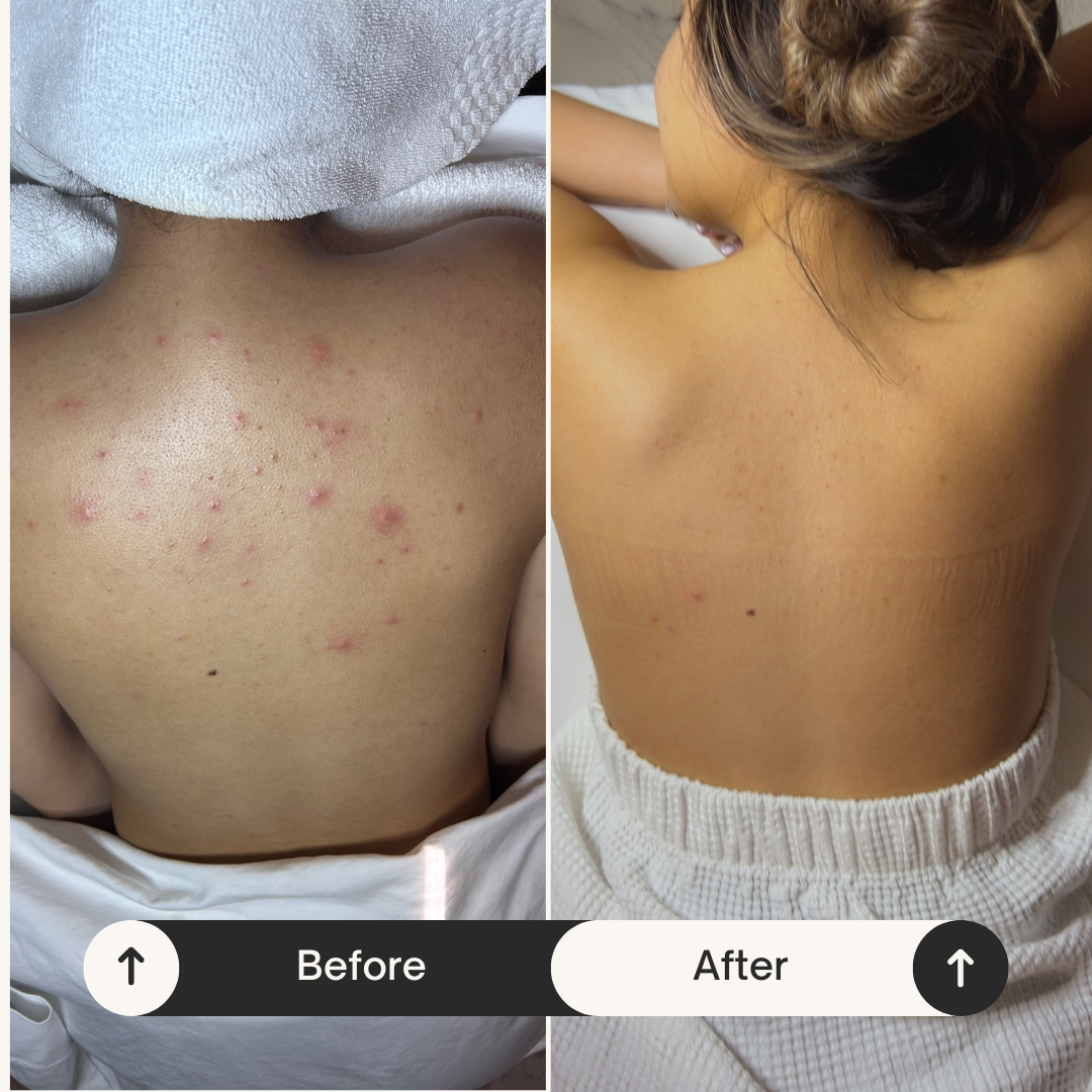 Before and after photos showing a person's back, illustrating the significant reduction of acne and skin blemishes.