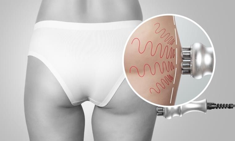 A Person is Having a Session of a Cryo Butt Lift — Your Body Revolution in Caloundra, QLD