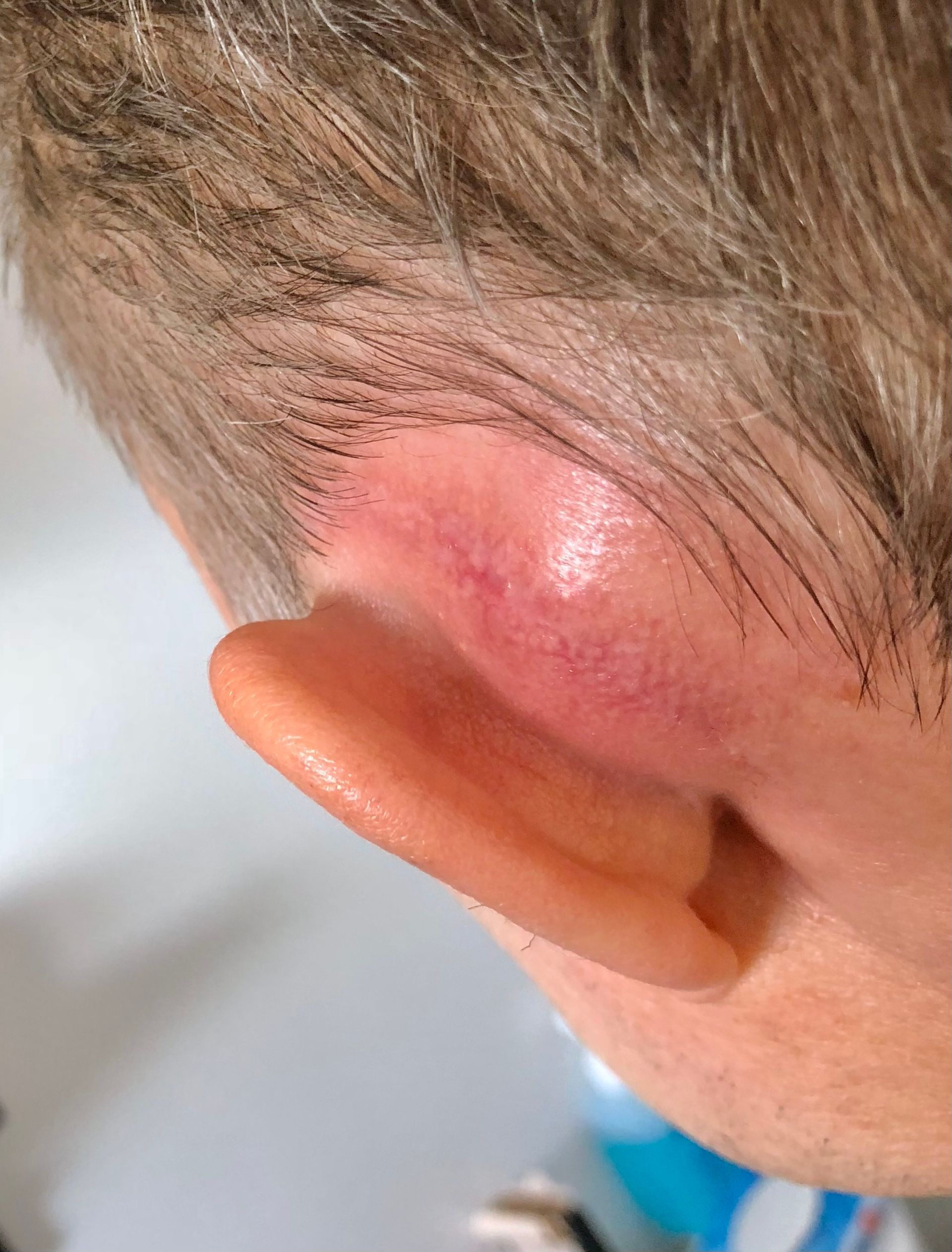 Mastoidectomy