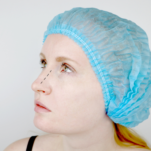 Septoplasty