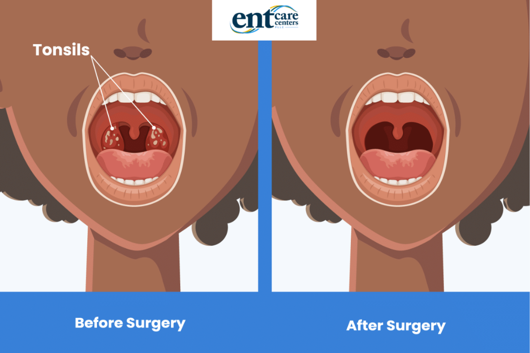 before-and-after-tonsillectomy