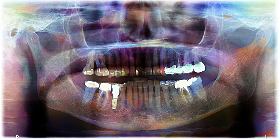 panoramica dentale