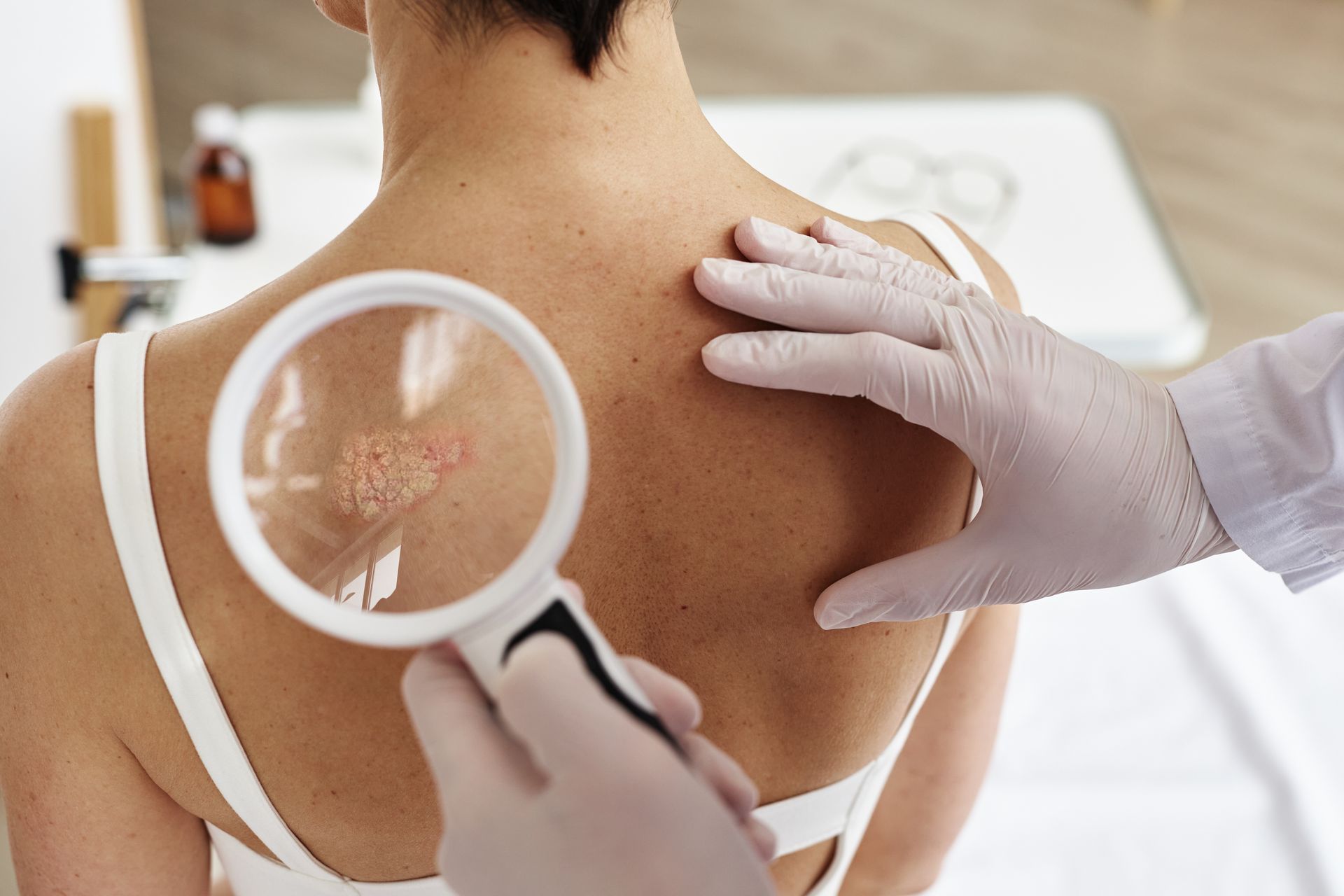 Dermatology specialist examining a skin lesion with a magnifying glass for professional diagnosis.