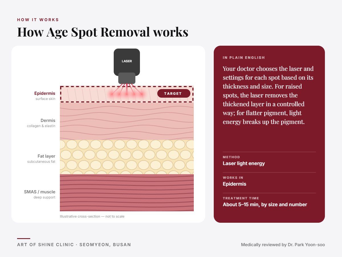 How Age Spot Removal works: illustrated skin cross-section showing laser light energy reaching the epidermis (surface skin)