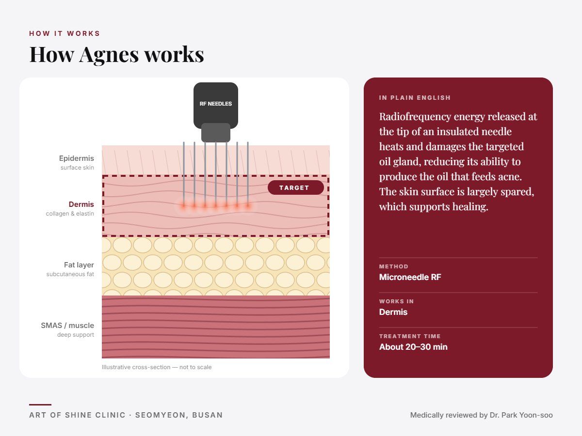 How Agnes works: illustrated skin cross-section showing microneedle RF reaching the dermis