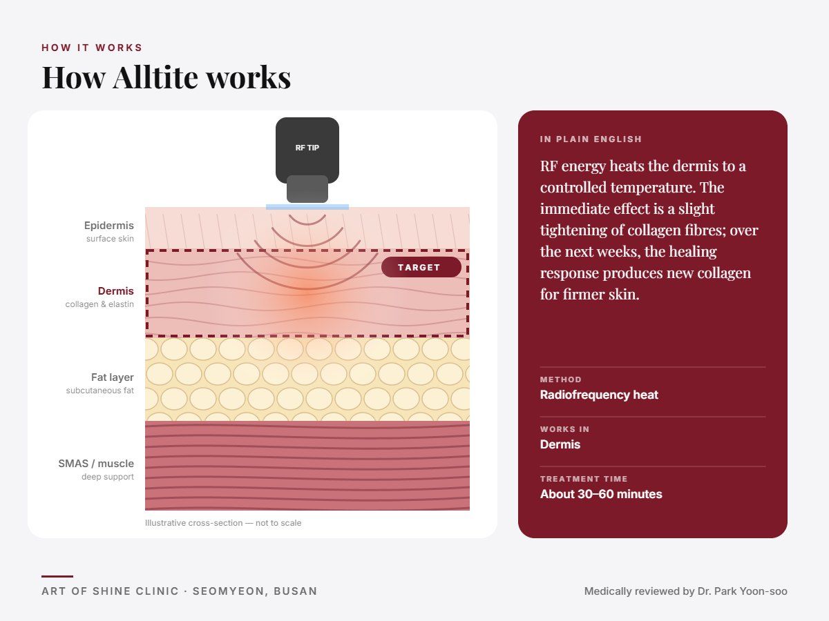 How Alltite works: illustrated skin cross-section showing radiofrequency heat reaching the dermis