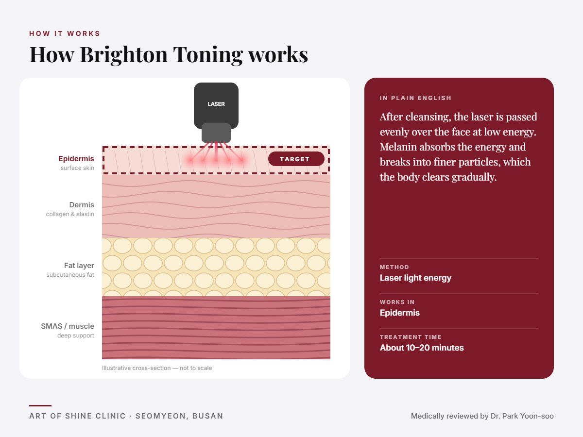 How Brighton Toning works: illustrated skin cross-section showing laser light energy reaching the epidermis (surface skin)