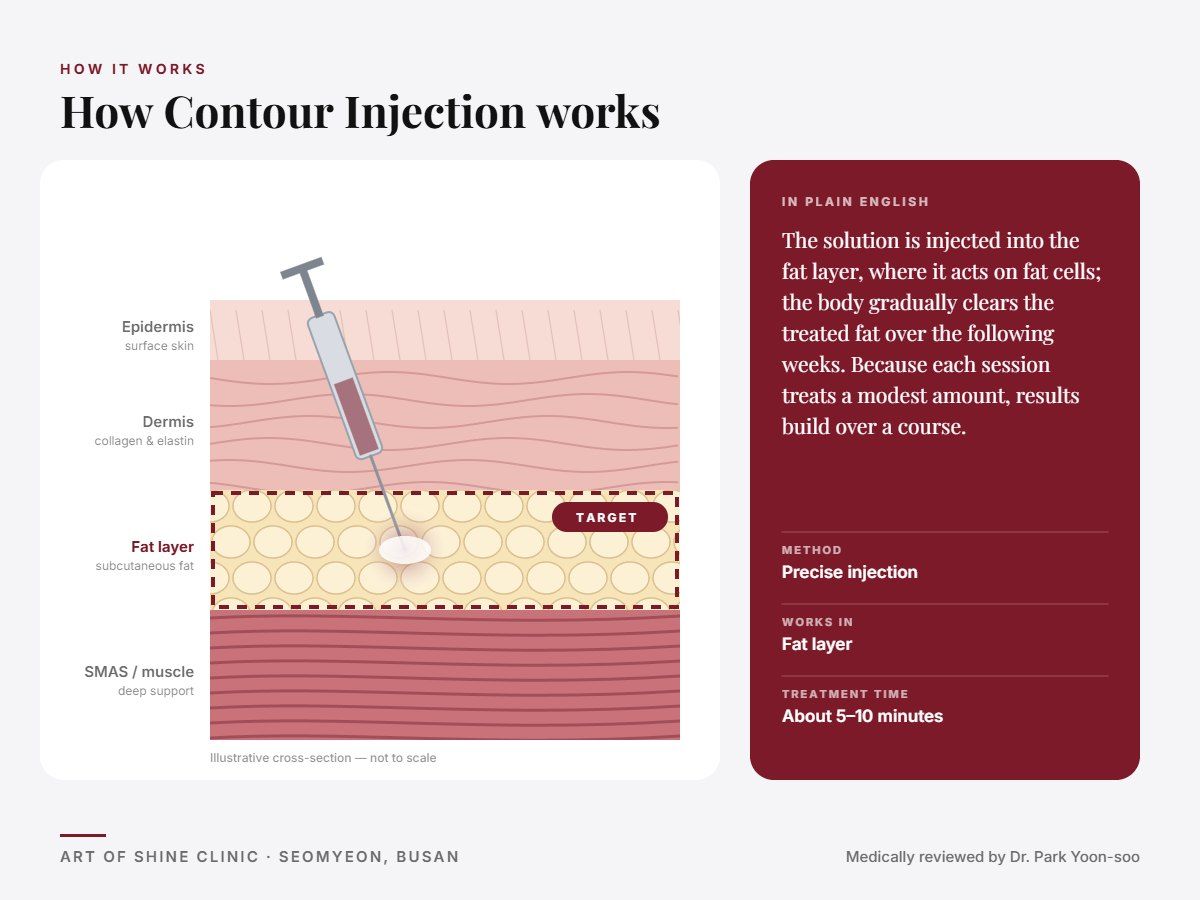 How Contour Injection works: illustrated skin cross-section showing precise injection reaching the fat layer