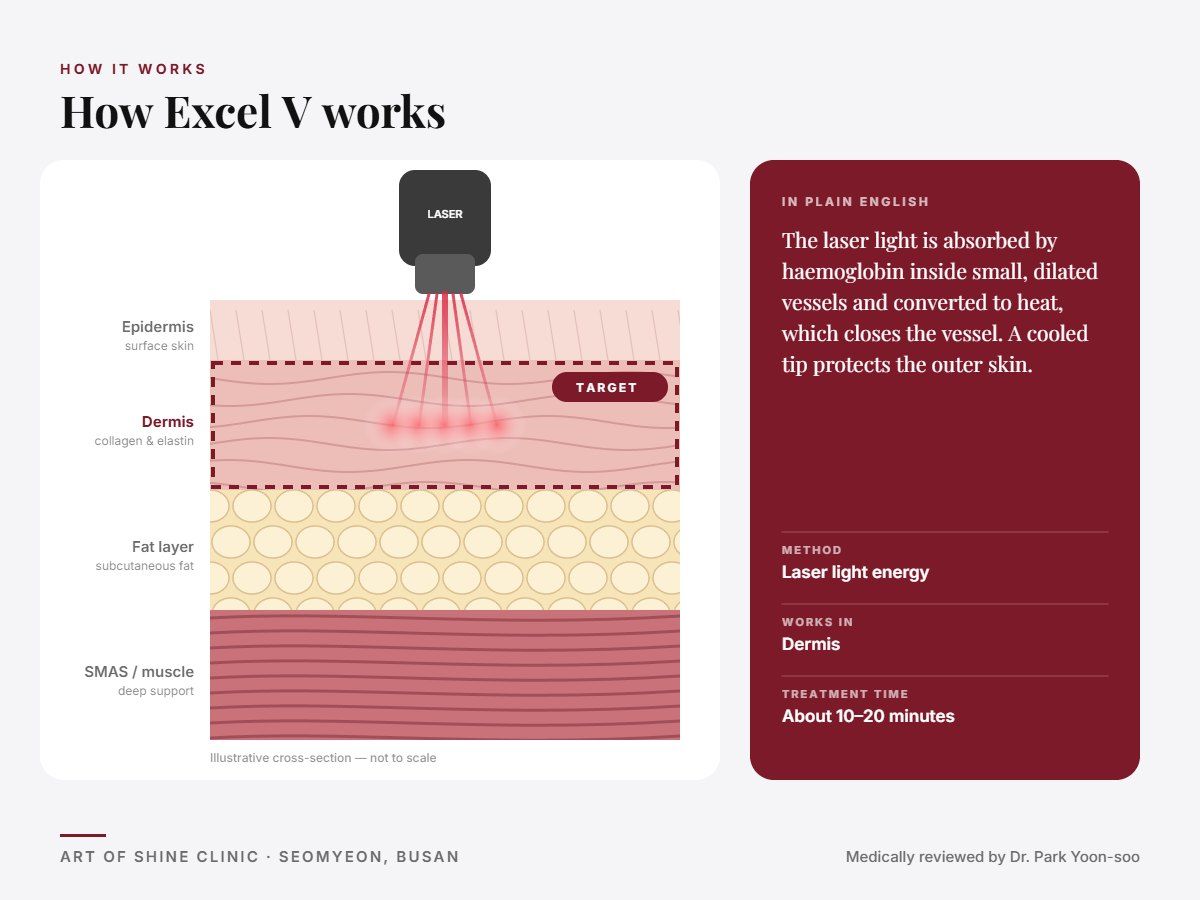 How Excel V works: illustrated skin cross-section showing laser light energy reaching the dermis