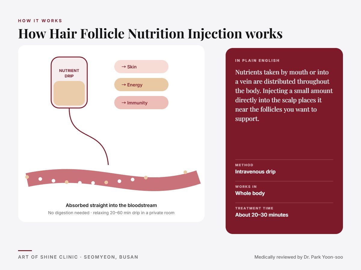 How Hair Follicle Nutrition Injection works: intravenous drip explained in a simple diagram