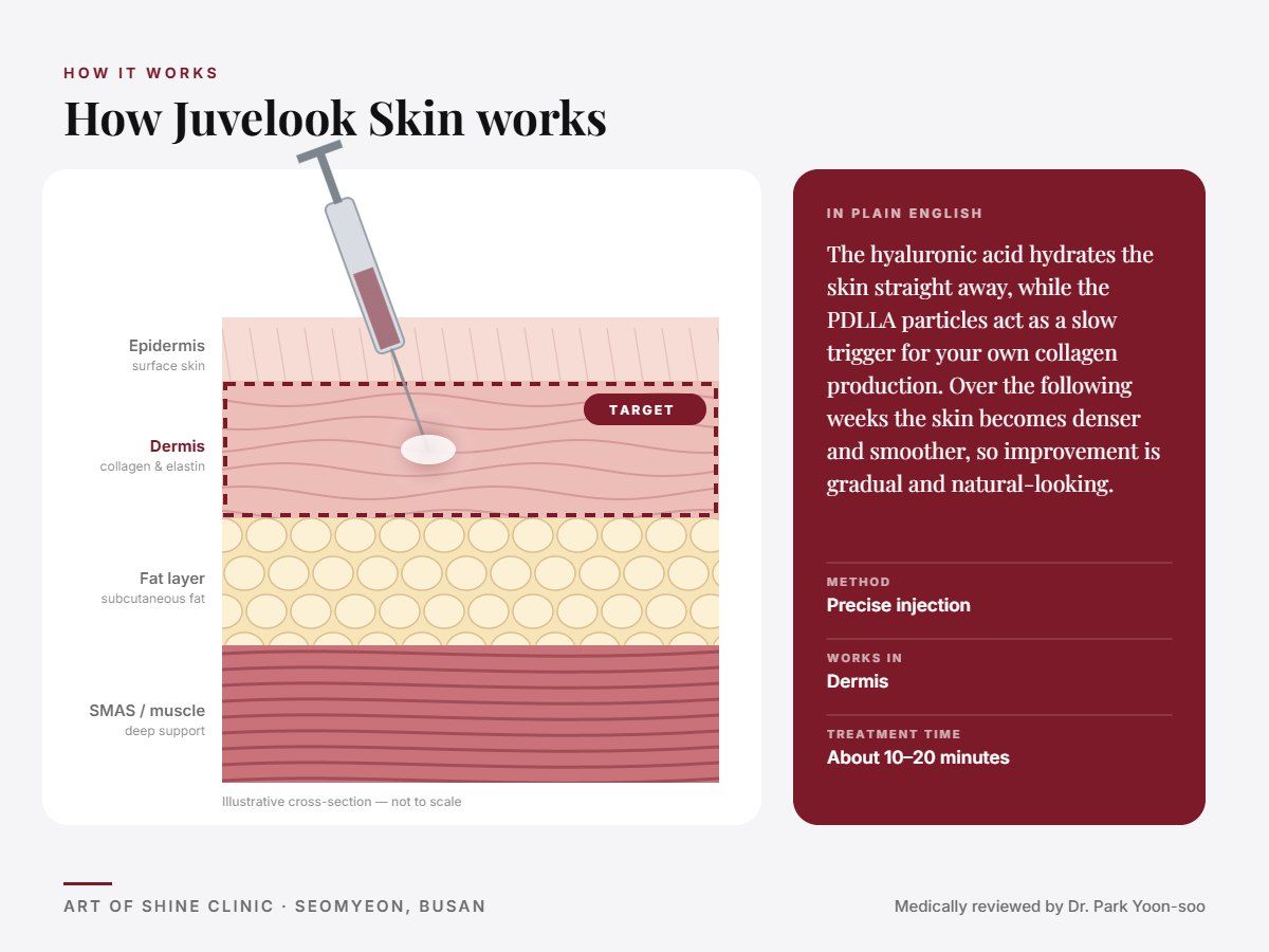 How Juvelook Skin works: illustrated skin cross-section showing precise injection reaching the dermis