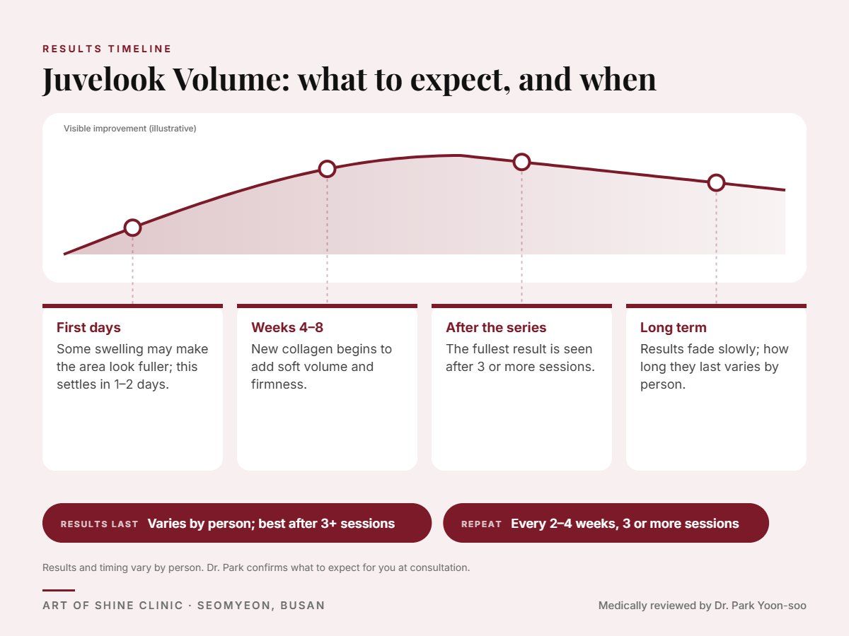 Juvelook Volume results timeline: when results appear and peak, and how long they last (Varies by person; best after 3+ sessions)