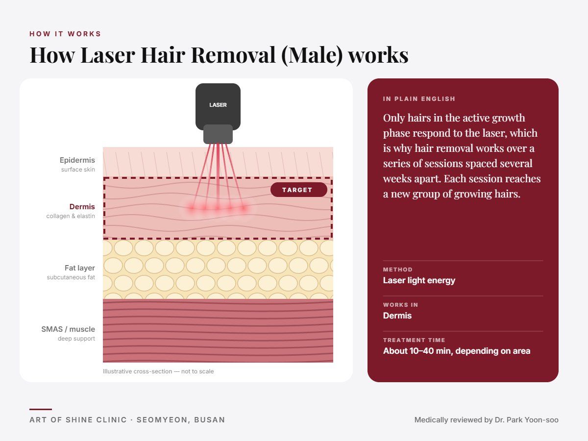 How Laser Hair Removal (Male) works: illustrated skin cross-section showing laser light energy reaching the dermis