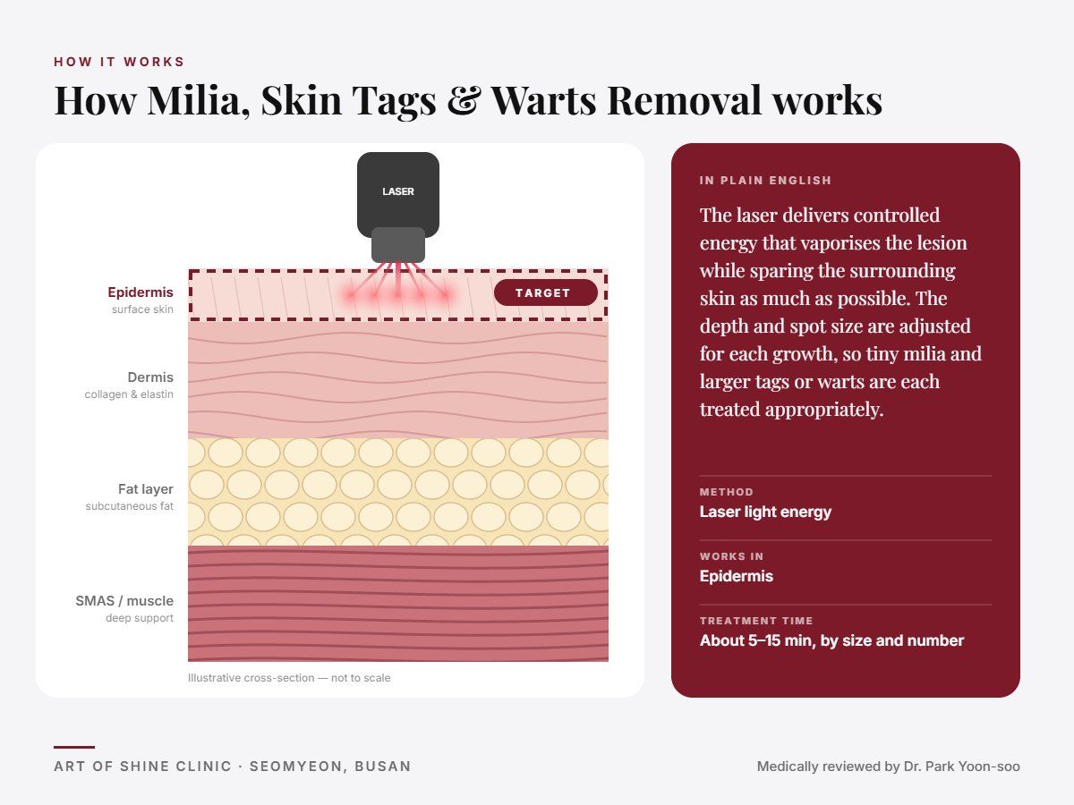 How Milia, Skin Tags & Warts Removal works: illustrated skin cross-section showing laser light energy reaching the epidermis (surface skin)