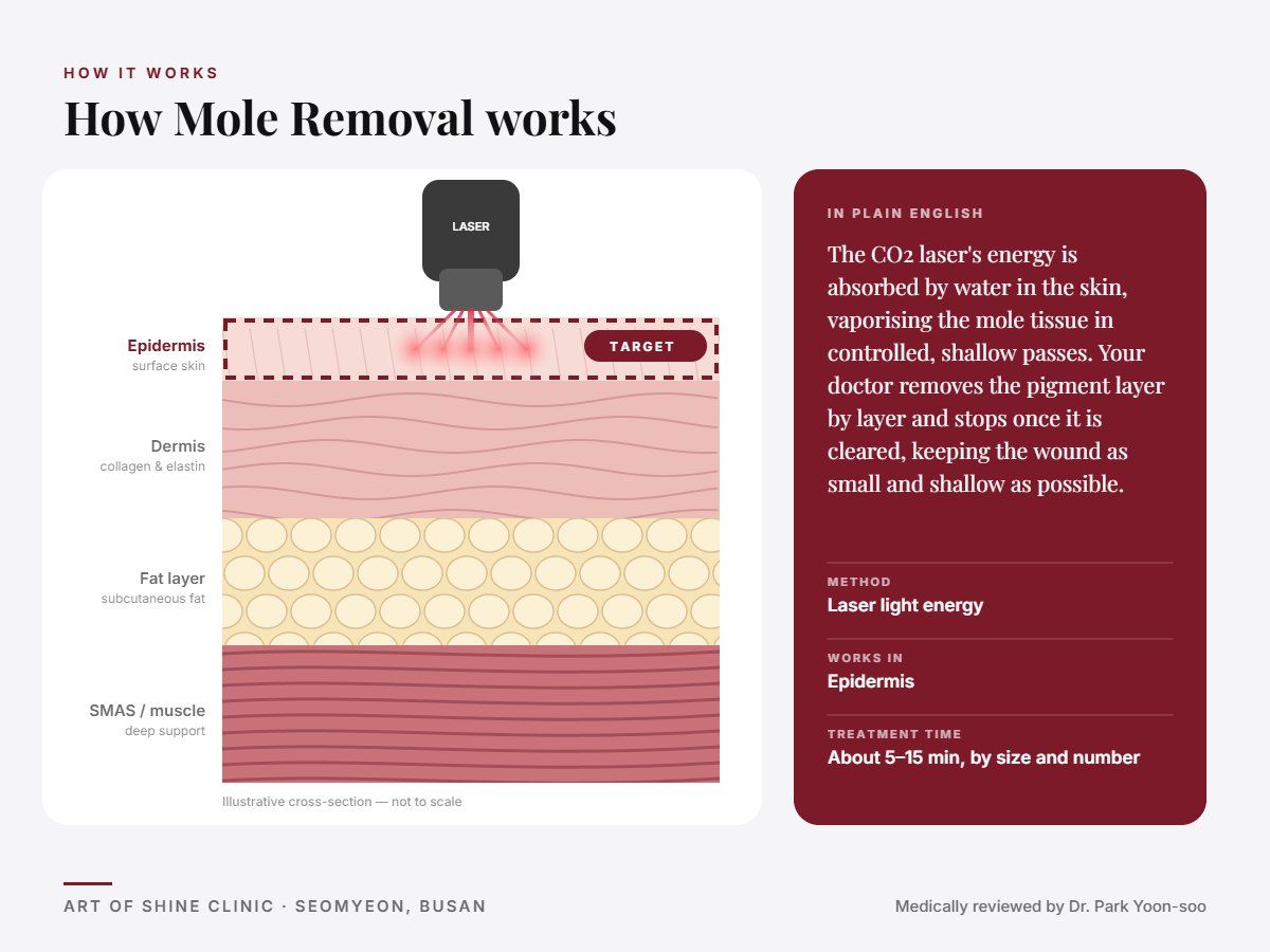 How Mole Removal works: illustrated skin cross-section showing laser light energy reaching the epidermis (surface skin)
