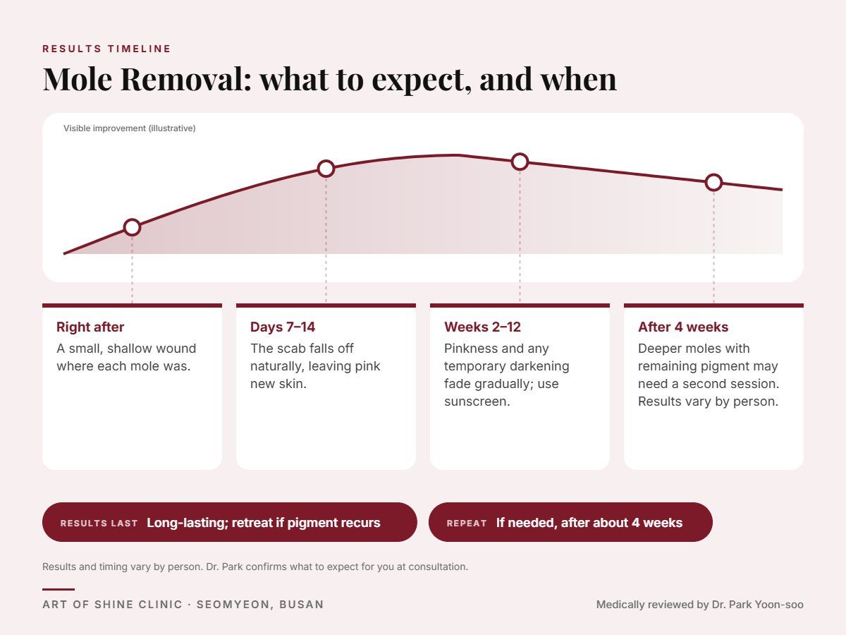 Mole Removal results timeline: when results appear and peak, and how long they last (Long-lasting; retreat if pigment recurs)