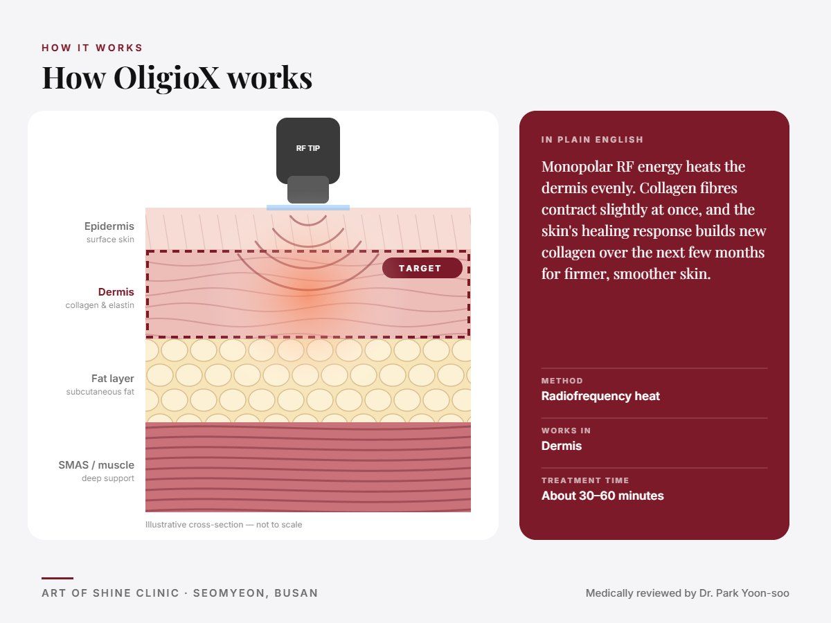 How OligioX works: illustrated skin cross-section showing radiofrequency heat reaching the dermis