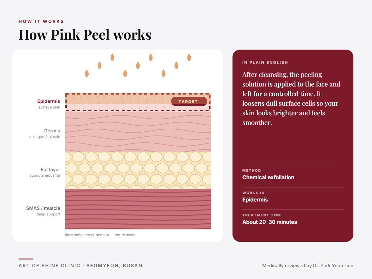 How Pink Peel works: illustrated skin cross-section showing chemical exfoliation reaching the epidermis (surface skin)