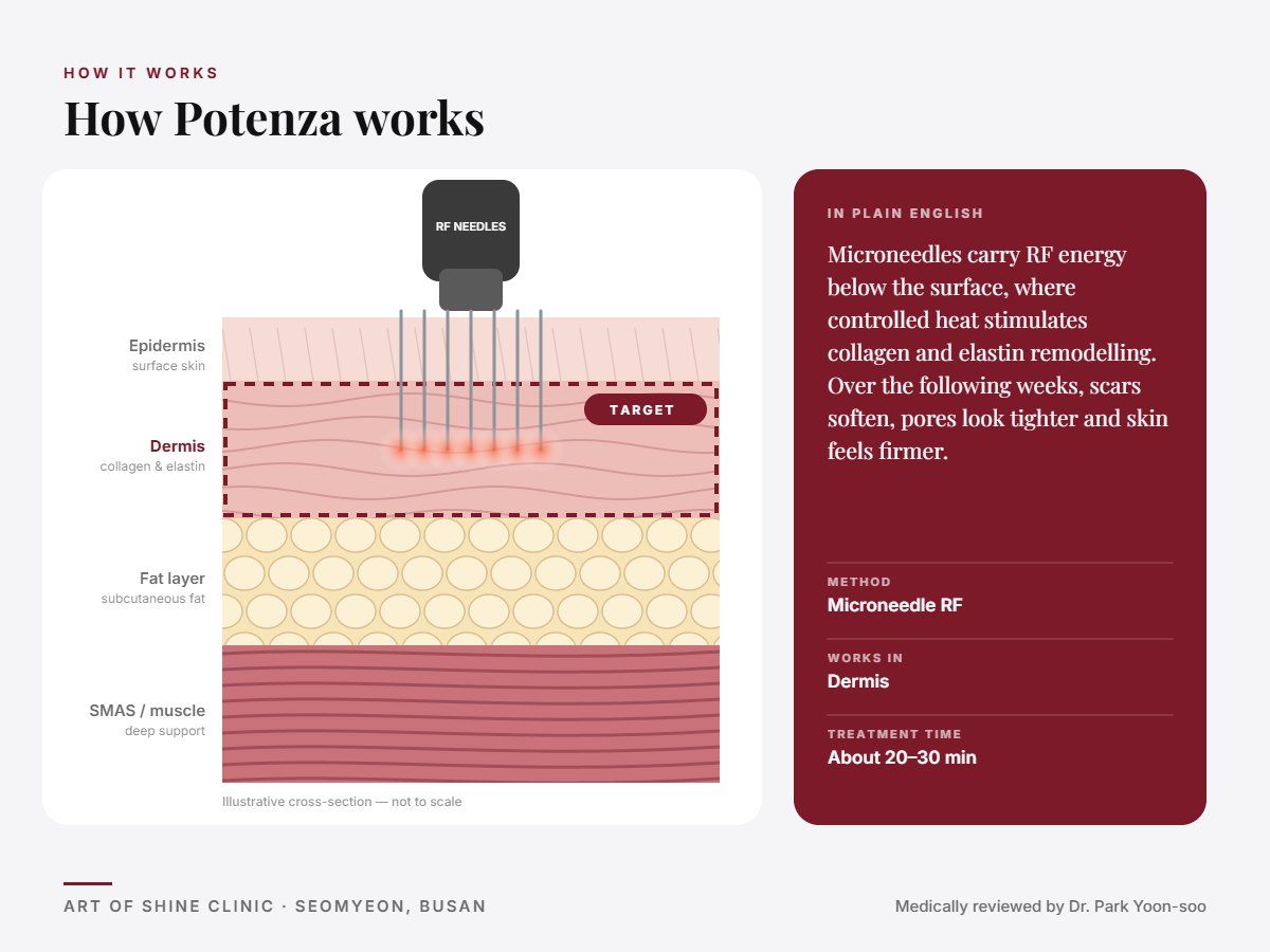 How Potenza works: illustrated skin cross-section showing microneedle RF reaching the dermis