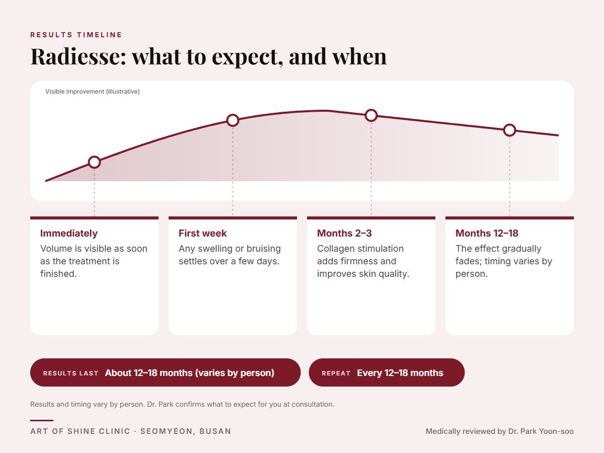 Radiesse results timeline: when results appear and peak, and how long they last (About 12&ndash;18 months)