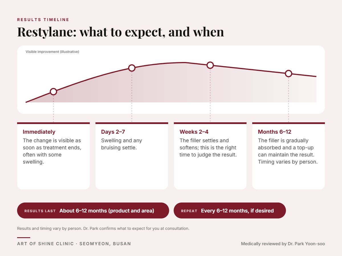 Restylane results timeline: when results appear and peak, and how long they last (About 6&ndash;12 months (product and area))