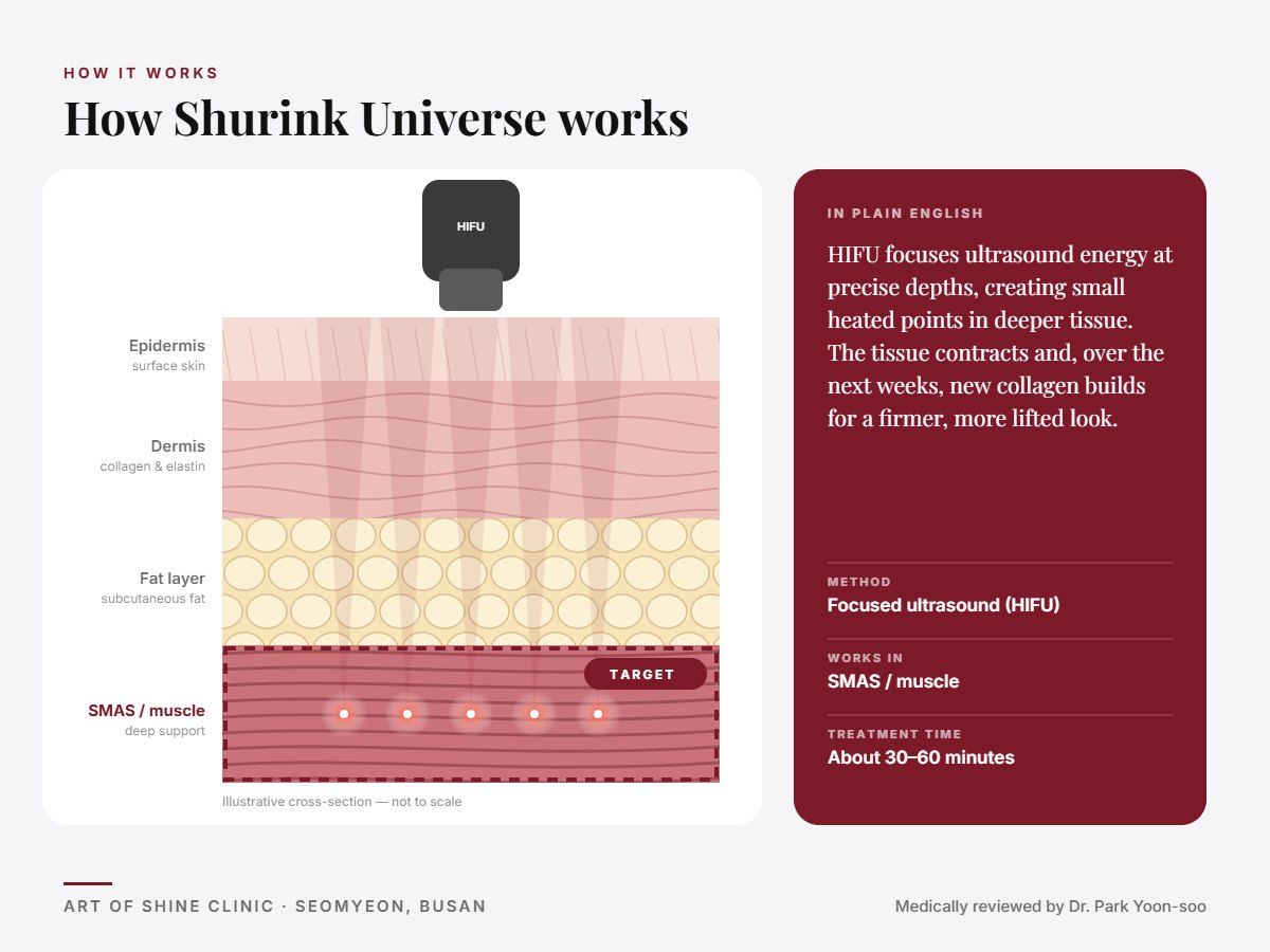 How Shurink Universe works: illustrated skin cross-section showing focused ultrasound (HIFU) reaching the SMAS and muscle layer