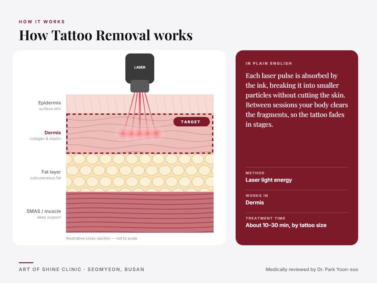 How Tattoo Removal works: illustrated skin cross-section showing laser light energy reaching the dermis